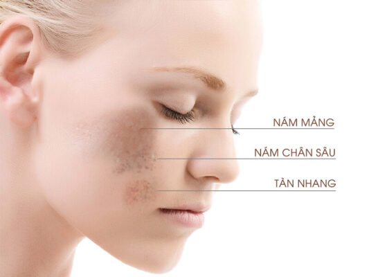 kem trị thâm nám hiệu quả nhất