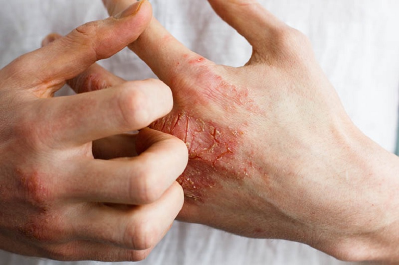 Những ai đang bị viêm da cơ địa có thể tham khảo bộ đôi của nhà Damos